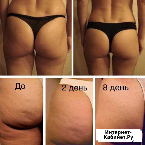 Массаж LPG Волгоград - изображение 1