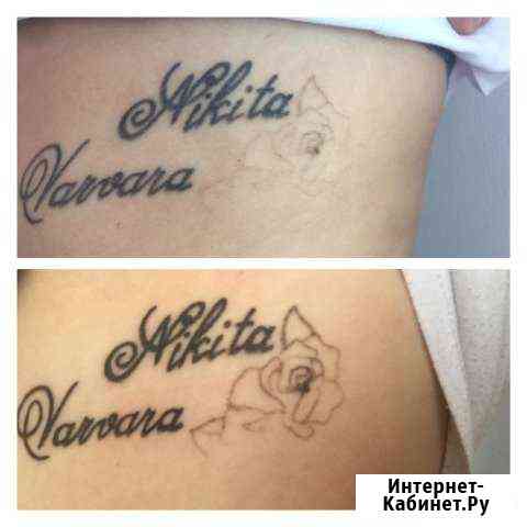 Лазерное удаление тату и татуажа Новосибирск