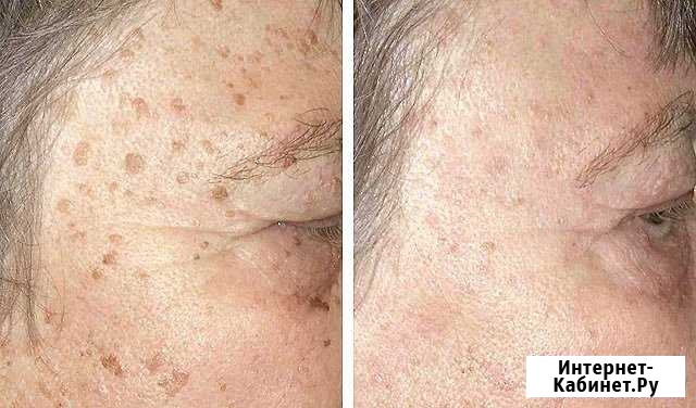 Plasma-liner Петрозаводск - изображение 1
