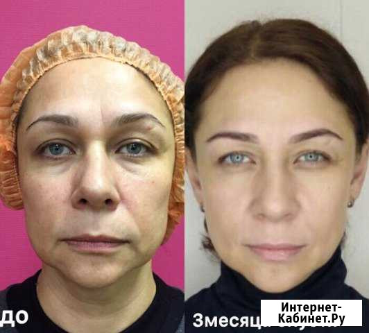 3D hifu smas лифтинг Великий Новгород - изображение 1
