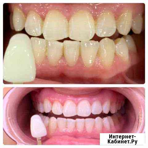 Косметическое отбеливание зубов Малоярославец