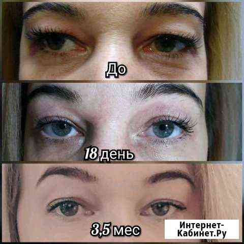 Косметическая процедура лифтинг аппаратный Первоуральск