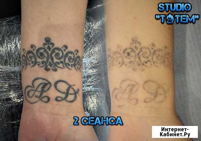 Лазерное сведение тату, Удаление татуажа Петропавловск-Камчатский - изображение 1
