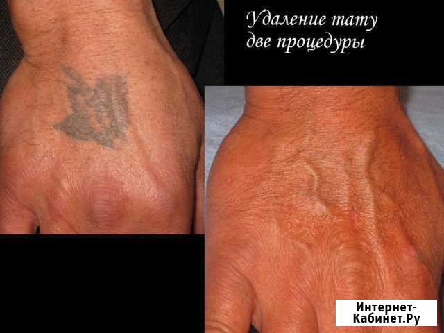 Лазерное удаление татуажа, тату Москва - изображение 1
