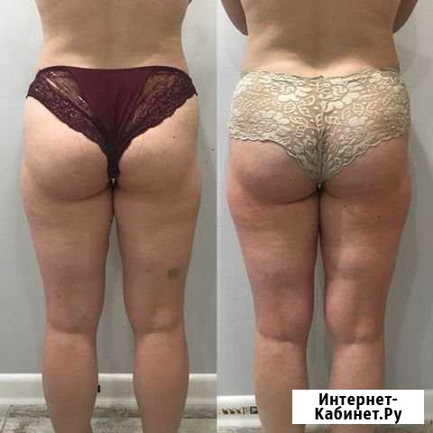 Антицеллюлитный массаж Оренбург - изображение 1