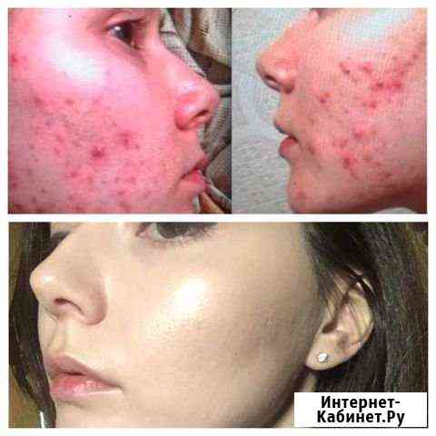 Ручная чистка лица Сочи