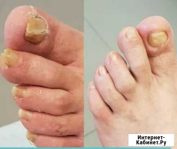 Педикюр пожилым,купание лежачих на дому Москва - изображение 1