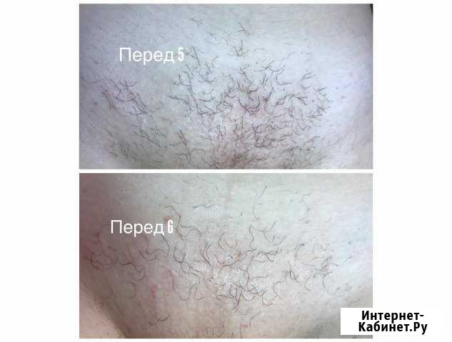 Электроэпиляция в Липецке Липецк - изображение 1