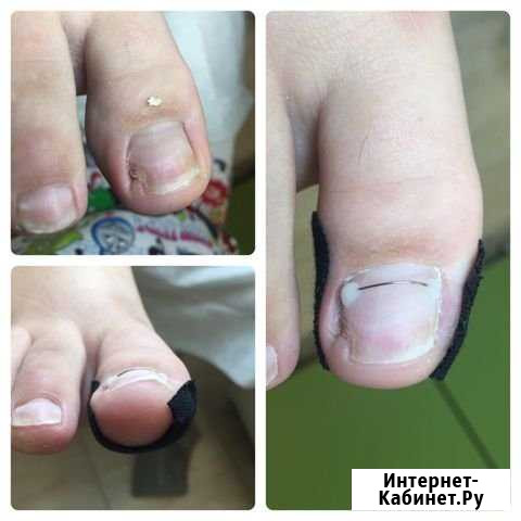 Медицинский педикюр на дому Санкт-Петербург - изображение 1