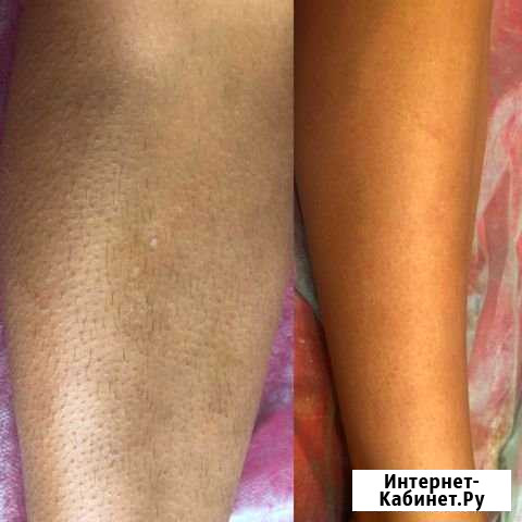 Шугаринг депиляция сахарной пастой Сочи - изображение 1