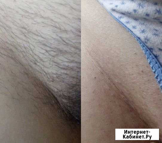 Шугаринг Туапсе - изображение 1