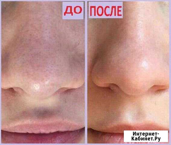 Ультразвуковая чистка лица Петропавловск-Камчатский - изображение 1