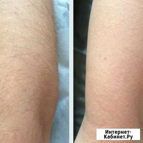 Шугаринг Махачкала - изображение 1