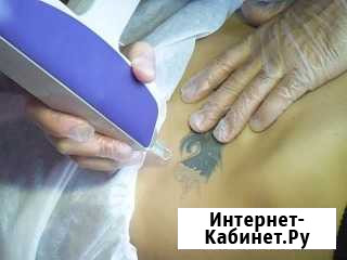 Удаление татуировок и татуажа в Ставрополе. Лазер Ставрополь - изображение 1