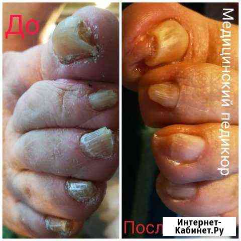 Медицинский педикюр.Выезд на дом.Любой р-он Санкт-Петербург