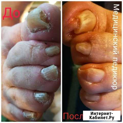 Медицинский педикюр.Выезд на дом.Любой р-он Санкт-Петербург - изображение 1