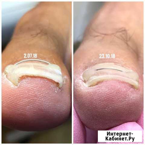 Педикюр, Маникюр, Титановая нить Петрозаводск - изображение 1