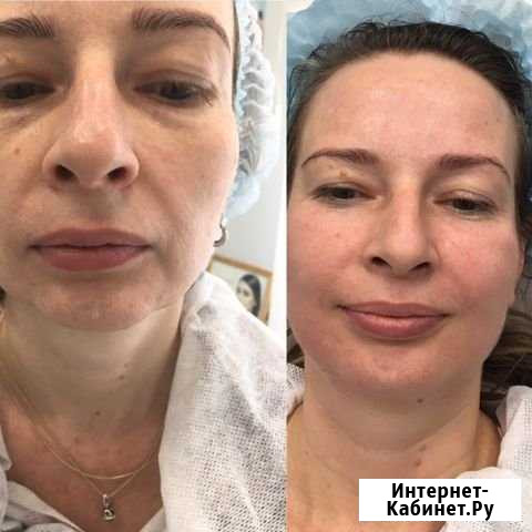 Массаж лица буккальный Королев - изображение 1