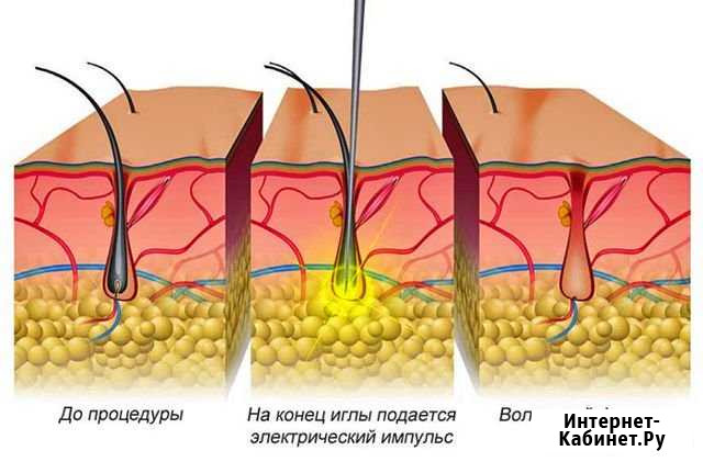 Электроэпиляция.Шугаринг Курск - изображение 1