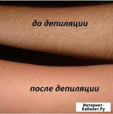 Депиляция Пятигорск - изображение 1