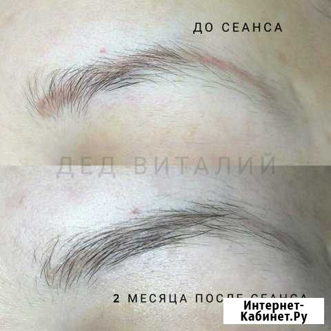 Удаление (выведение) тату (татуировок) и татуажа Москва - изображение 1