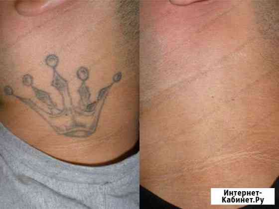 Удаление тату Нижний Новгород