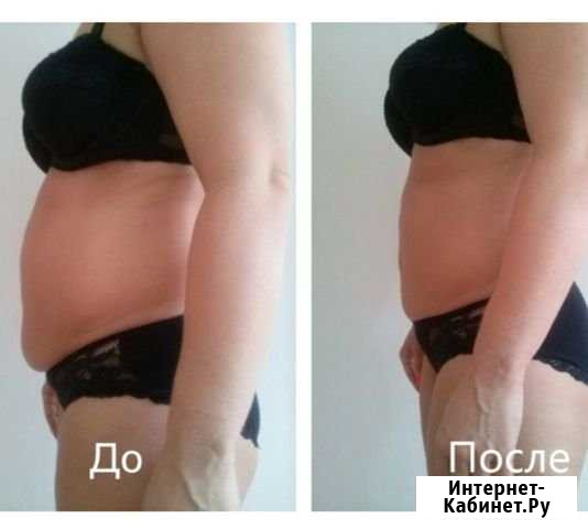 Коррекция фигуры, похудение Обьгэс Новосибирск - изображение 1