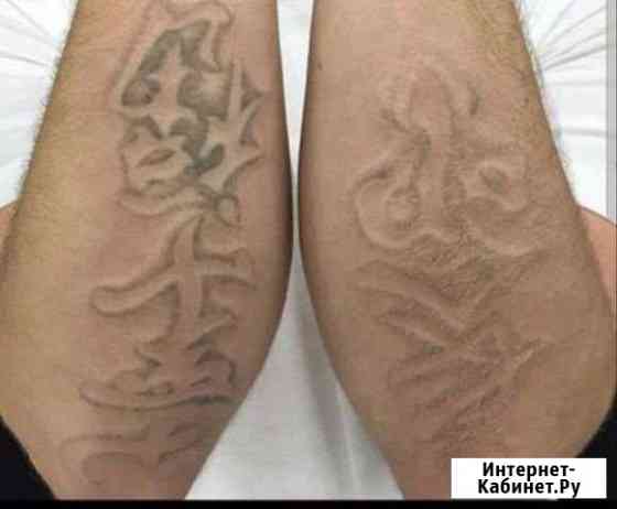 Удаление татуировок, татуажа Ярославль