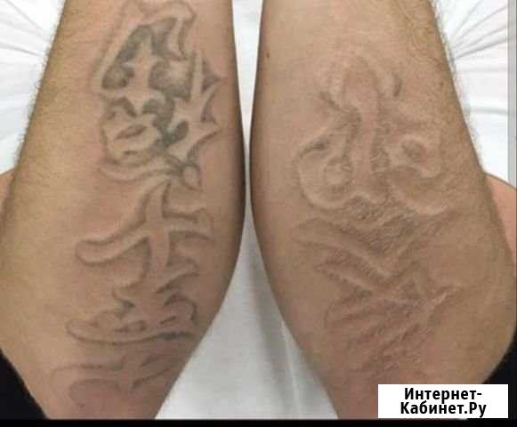 Удаление татуировок, татуажа Ярославль - изображение 1