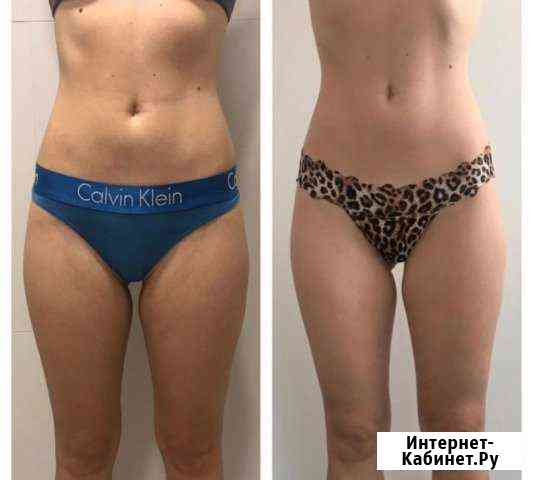 LPG массаж Сочи