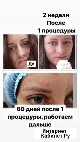 Удаление татуажа Ковров - изображение 1