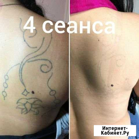 Удаление татуировок и татуажа Королёв, Мытищи Королев - изображение 1