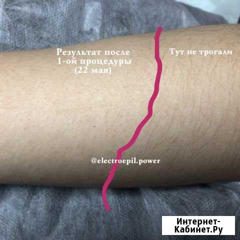 Электроэпиляция Жулебино Люберцы - изображение 1