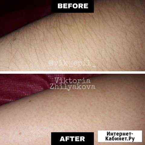 Шугаринг Подольск