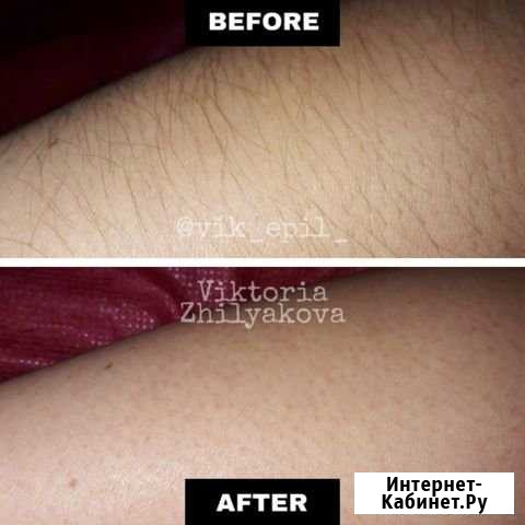 Шугаринг Подольск - изображение 1