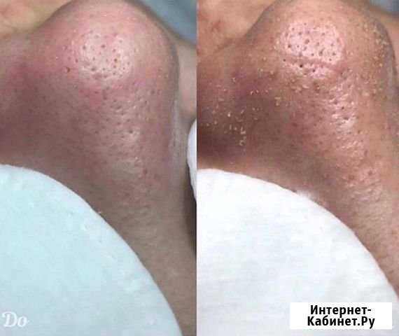 Чистка лица Симферополь - изображение 1