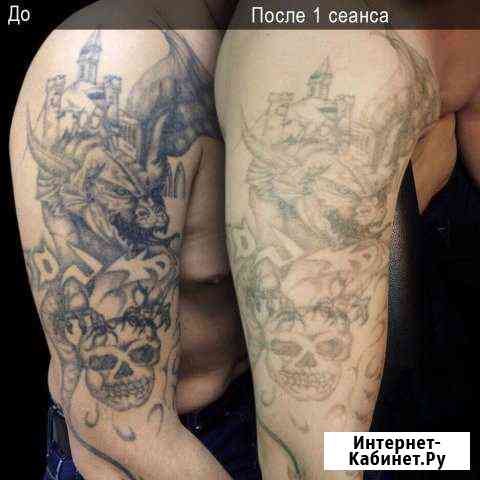 Лазерное удаление тату и татуажа Москва