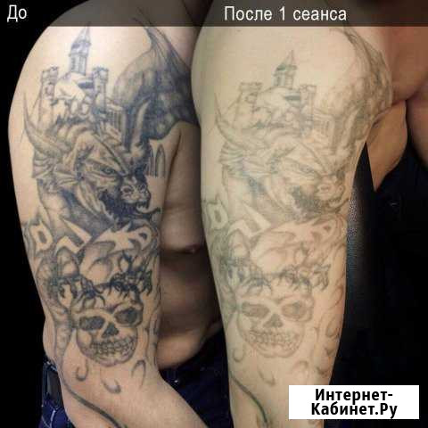 Лазерное удаление тату и татуажа Москва - изображение 1