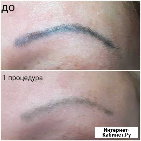 Удаление татуажа Киров - изображение 1