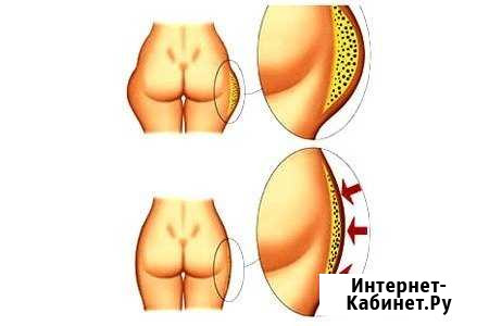 Кавитация идеальный способ похудения Санкт-Петербург - изображение 1