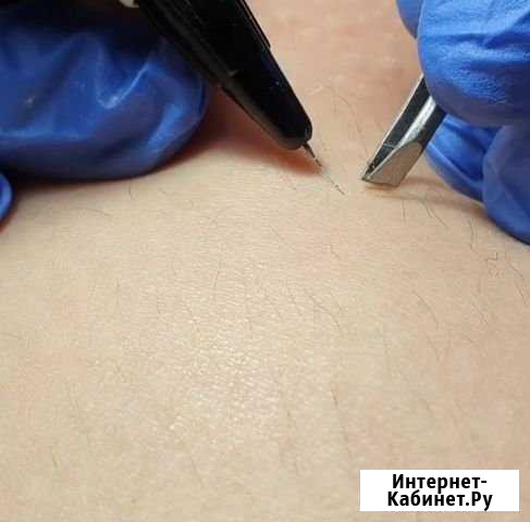 Электроэпиляция Раменское - изображение 1