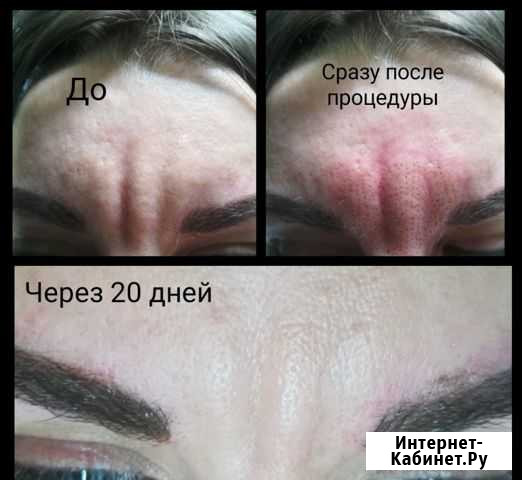 Plasma-liner Удаление морщин, папиллом Балаково - изображение 1