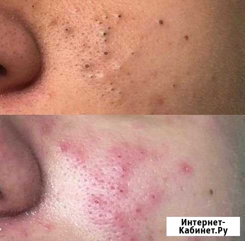 Чистка лица Ростов-на-Дону - изображение 1
