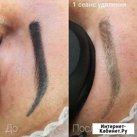 Удаление тату Нижний Новгород - изображение 1
