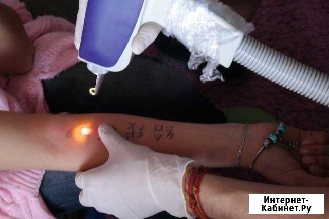 Лазерное удаление татуировок и татуажа Санкт-Петербург - изображение 1