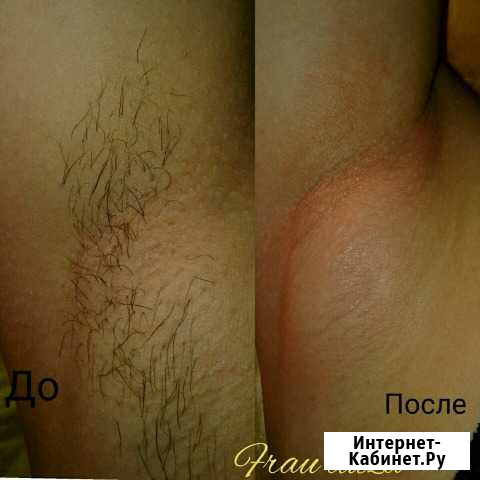 Шугаринг Астрахань - изображение 1