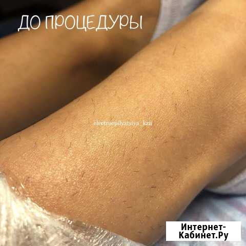 Электроэпиляция Казань - изображение 1