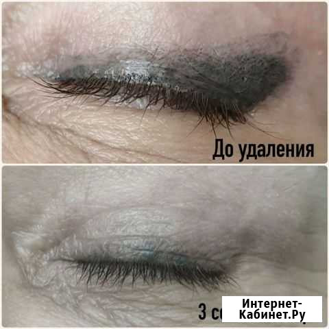 Удаление татуажа Ханты-Мансийск - изображение 1
