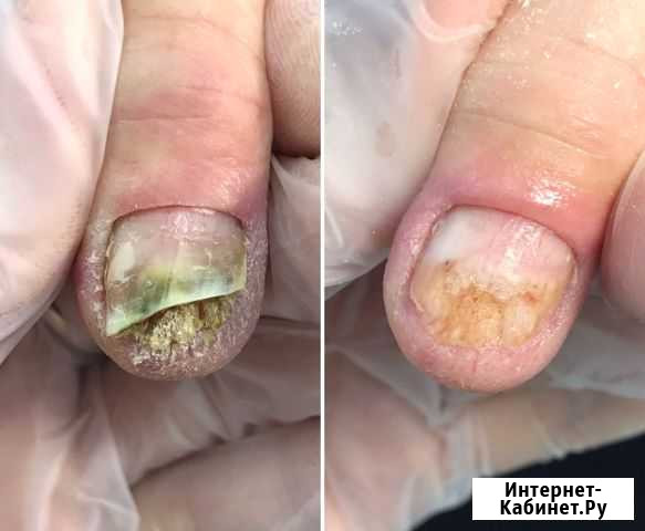 Медицинский педикюр. Вросший ноготь Череповец - изображение 1