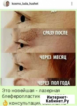 Лазерная блеферопластика Новый Хушет - изображение 1